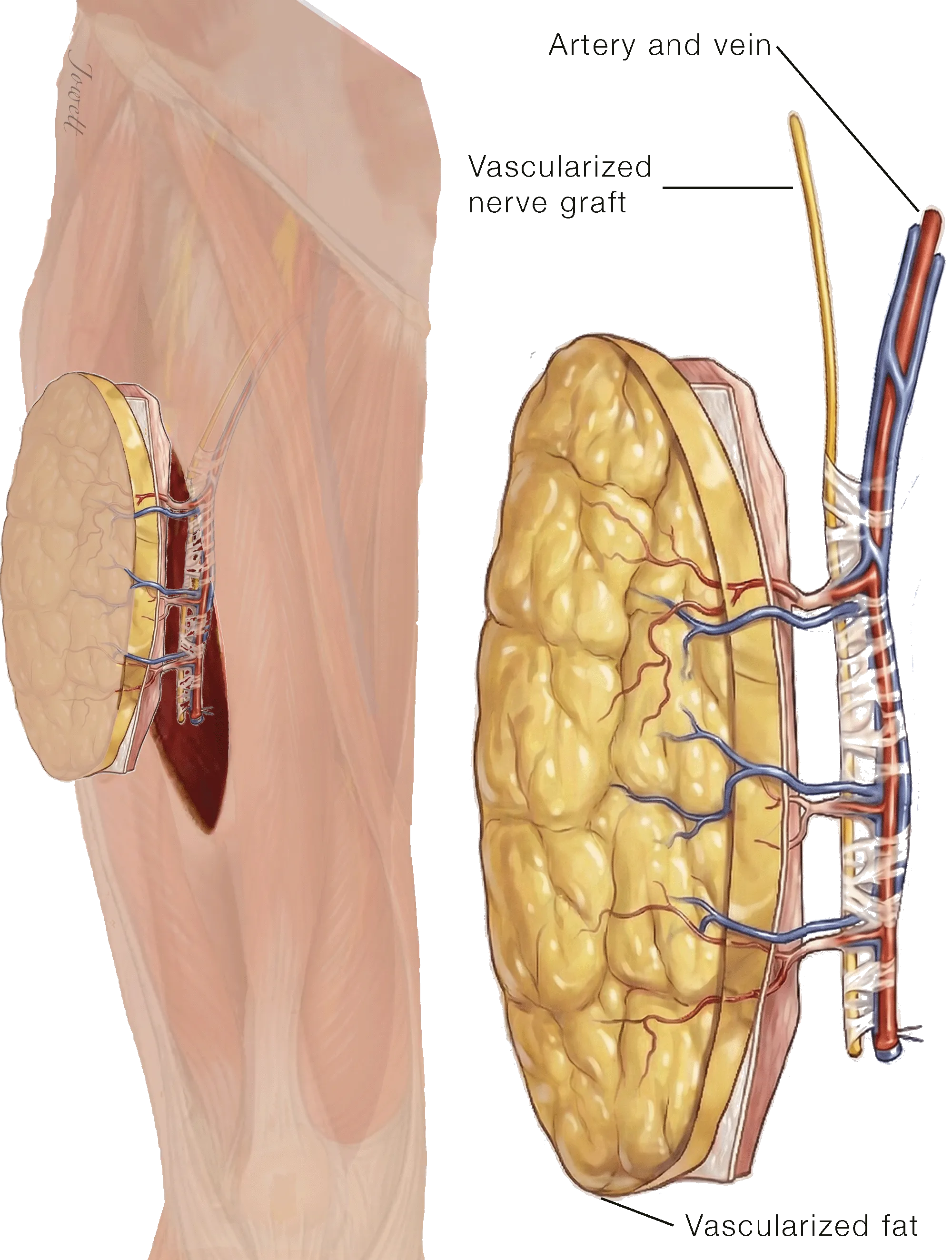 Anterolateral Thigh (ALT) Flap Harvest