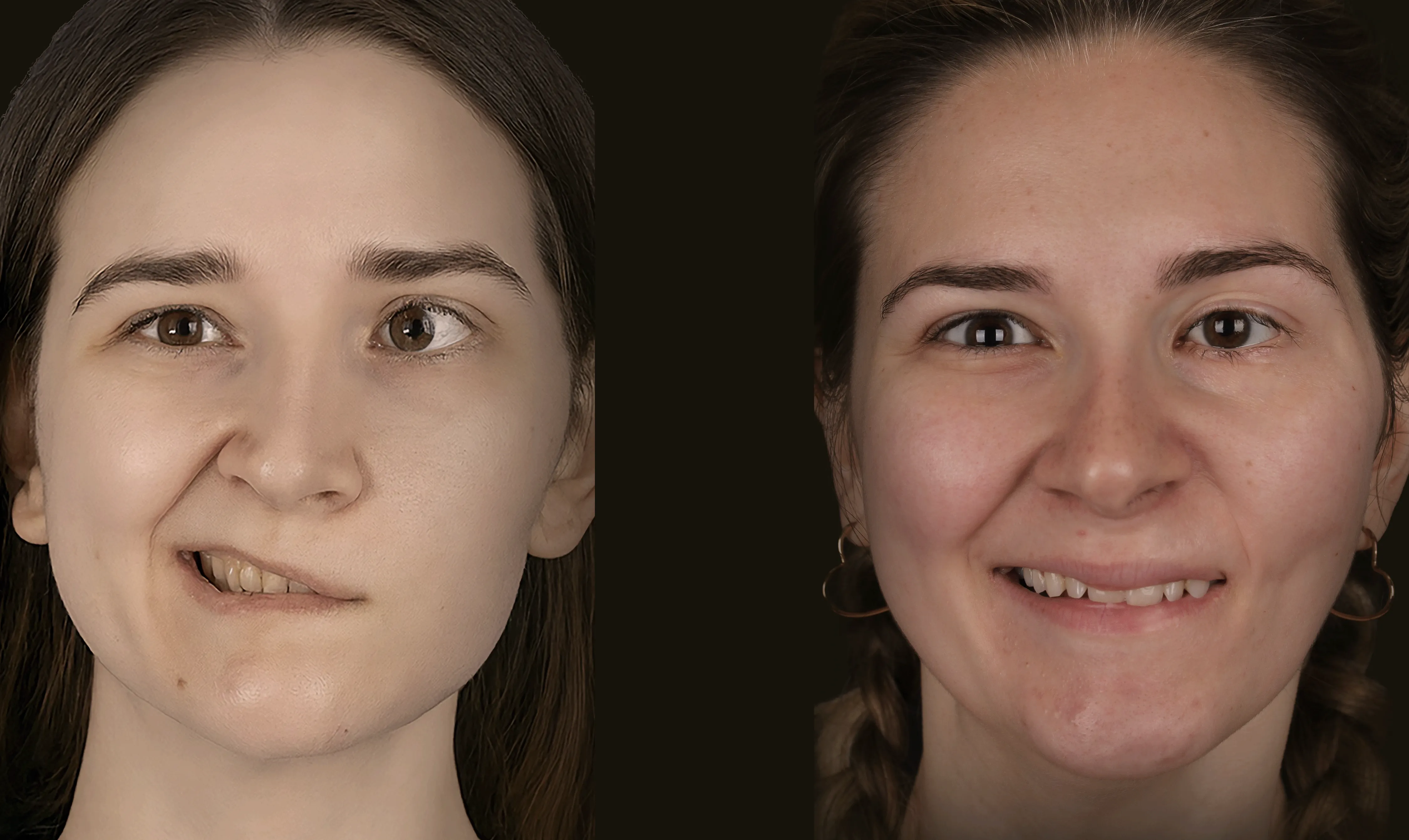 Before and after photos of a patient who underwent comprehensive facial reanimation with a gracilis muscle transfer after a brainstem tumor resection