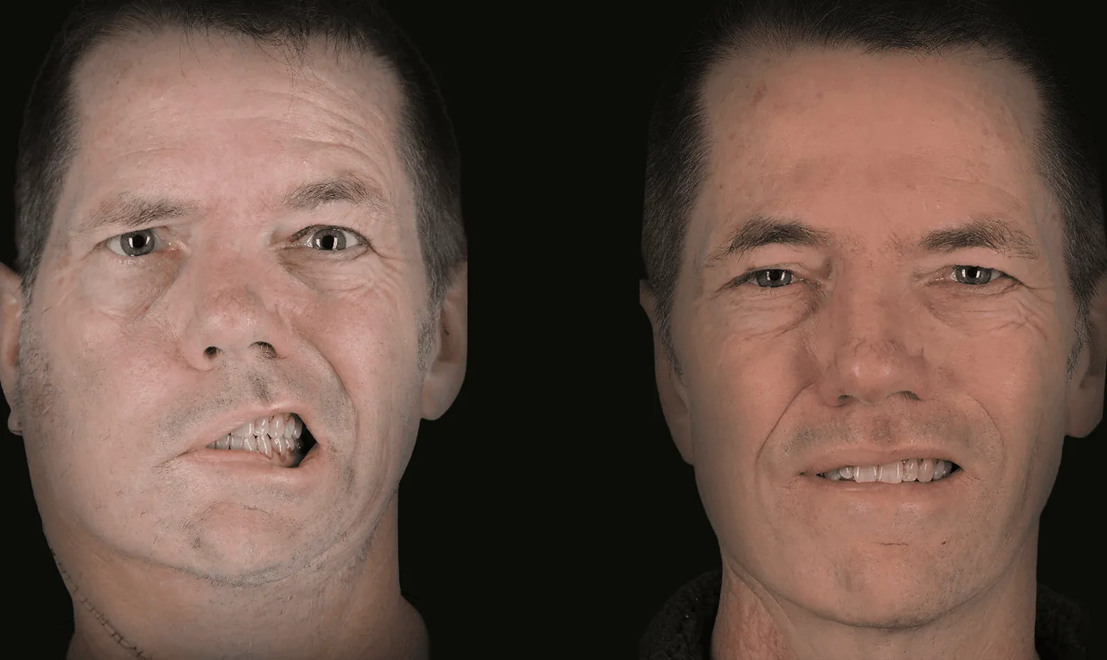 Before and after parotid cancer facial nerve reconstruction