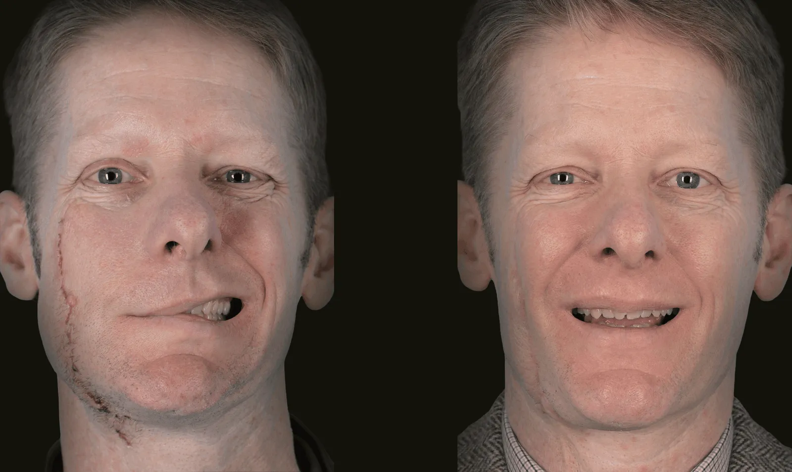 Before and after repair of a traumatic facial nerve injury