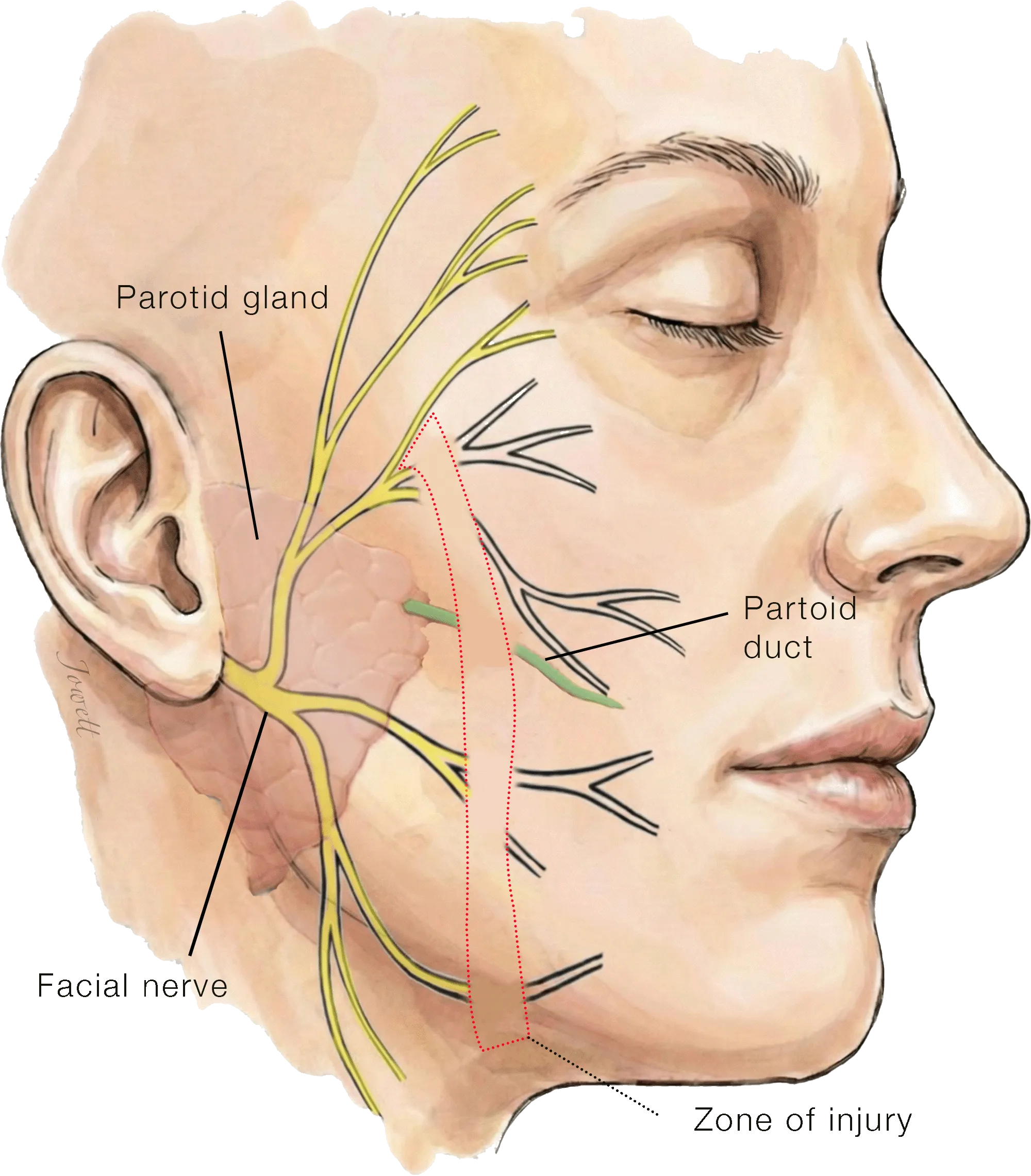 Anatomy of the injury showing severed facial nerve and parotid duct