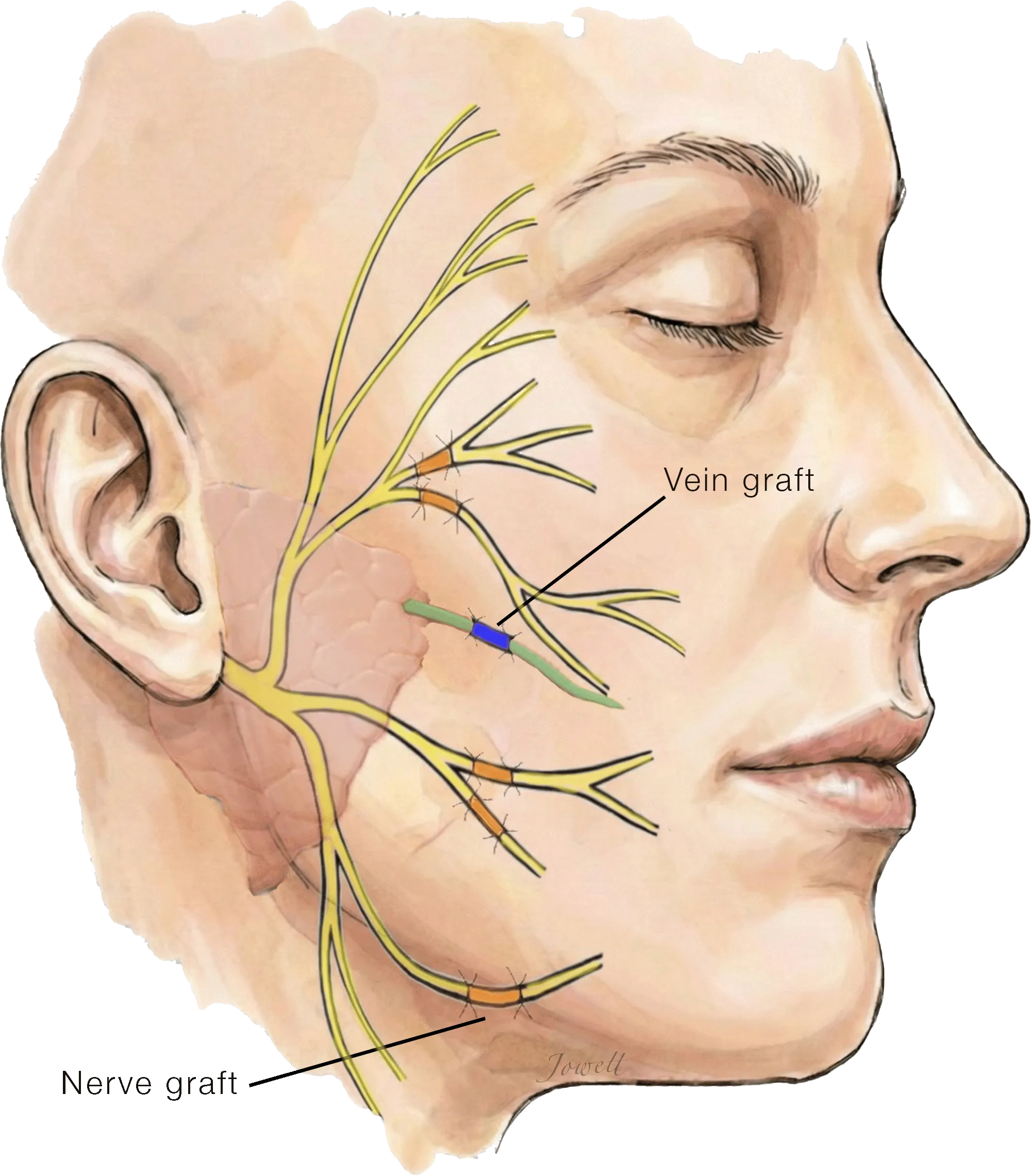 Surgical reconstruction with nerve and vein grafts