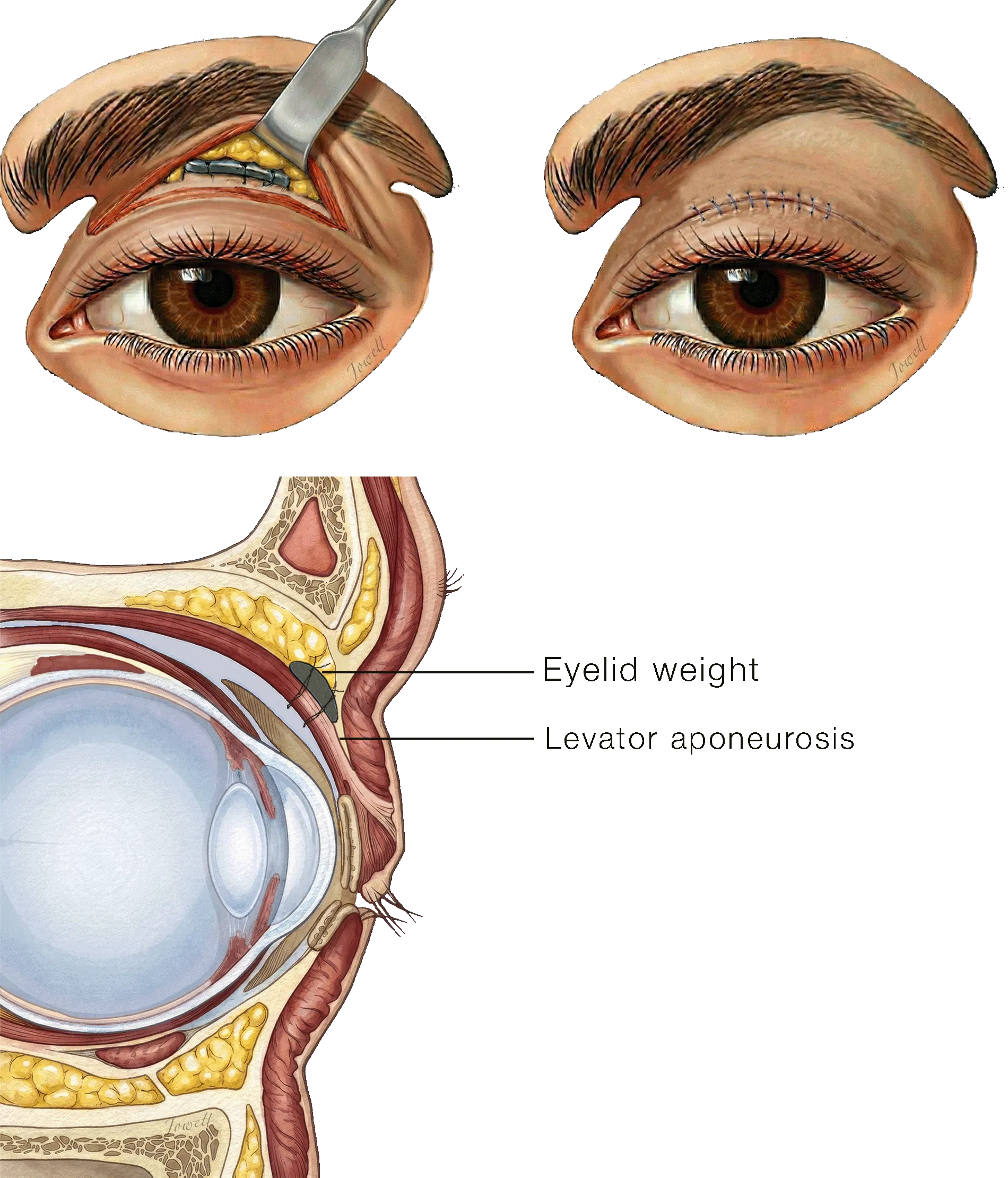 Illustration of upper eyelid weight placement above the tarsus, seated against the levator aponeurosis, shown through an eyelid-crease incision and in cross-section