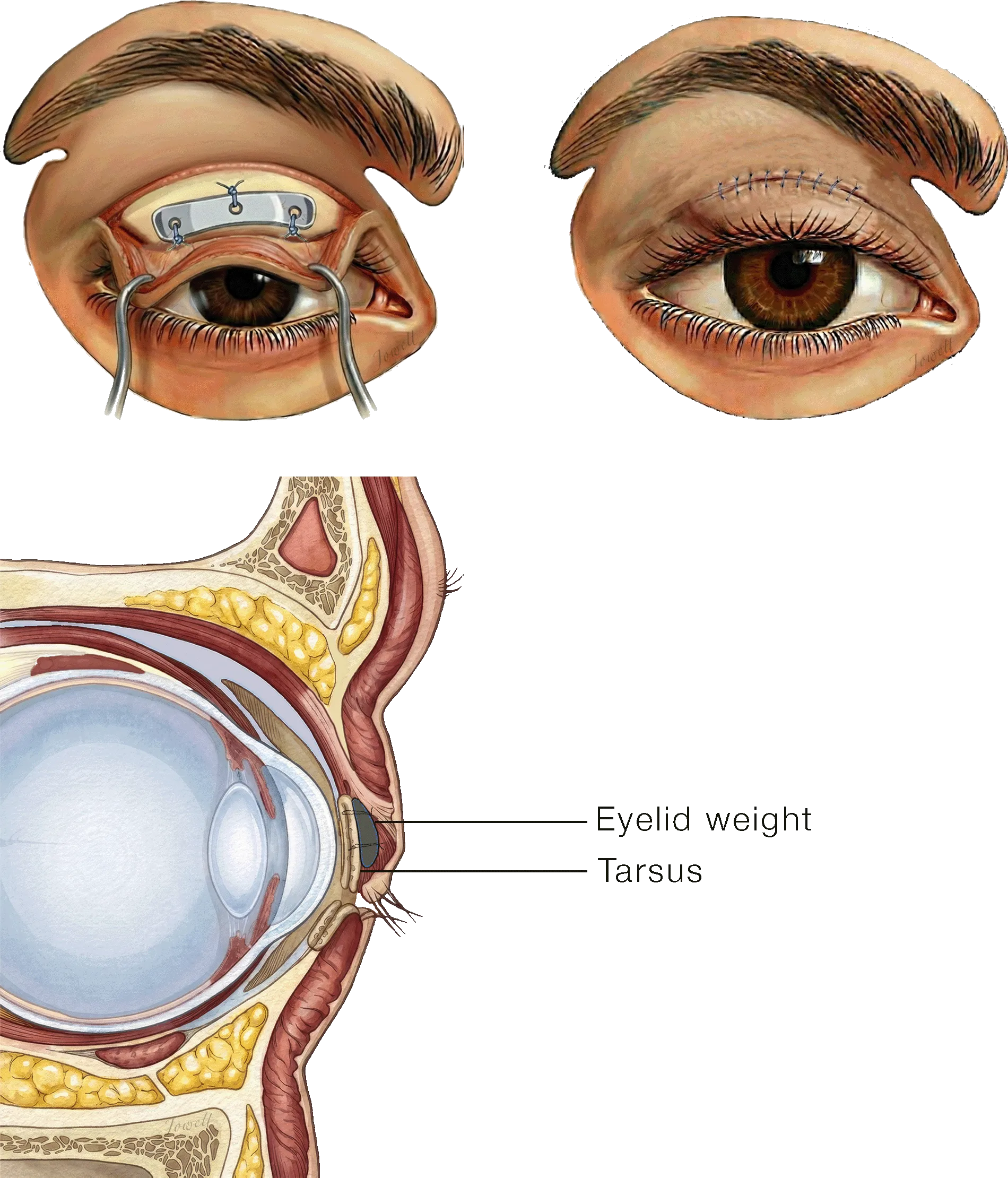 Illustration of an upper eyelid weight fixed directly to the tarsus with sutures, shown through an eyelid-crease incision and in cross-section