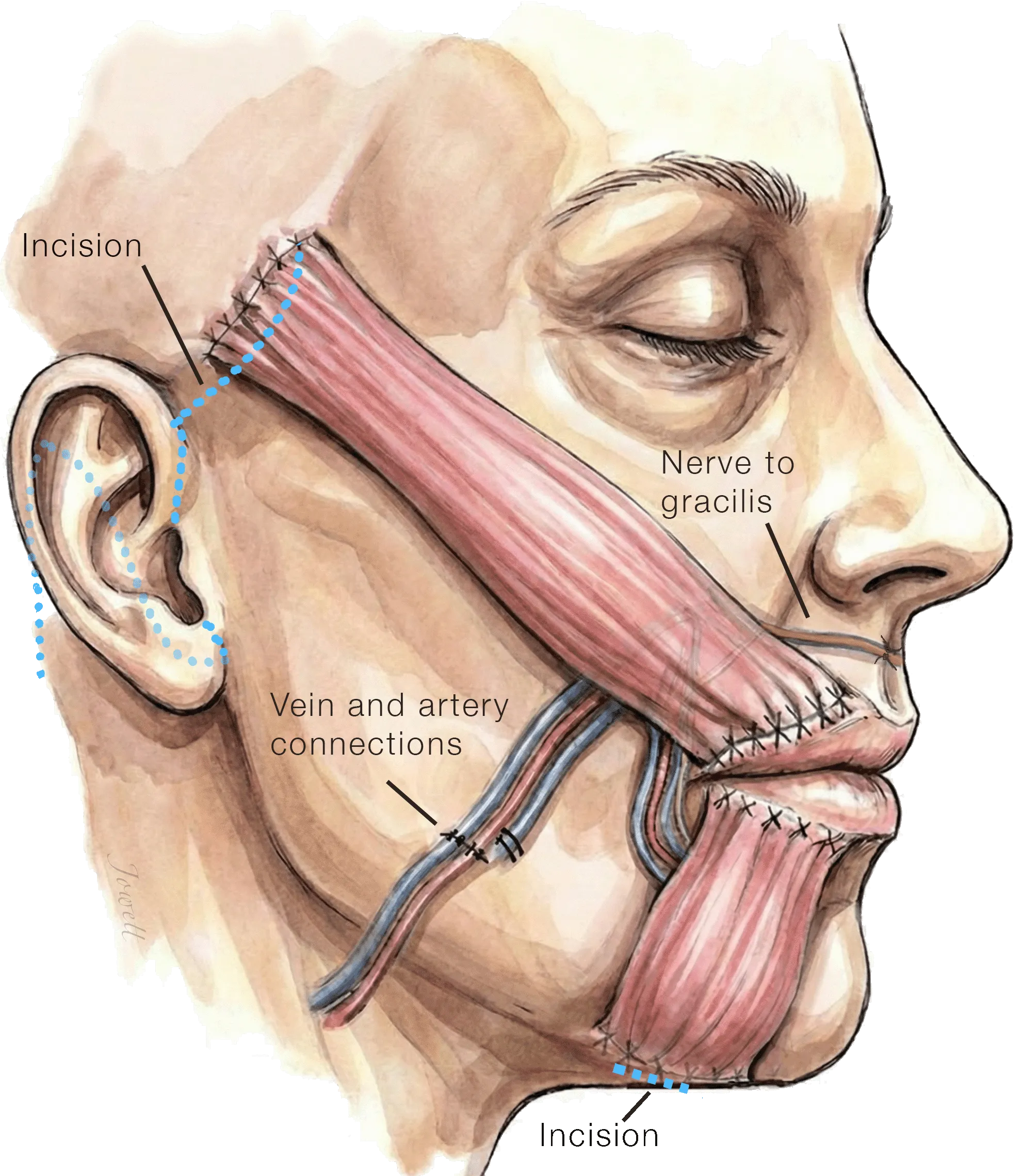Free Gracilis Muscle Transfer