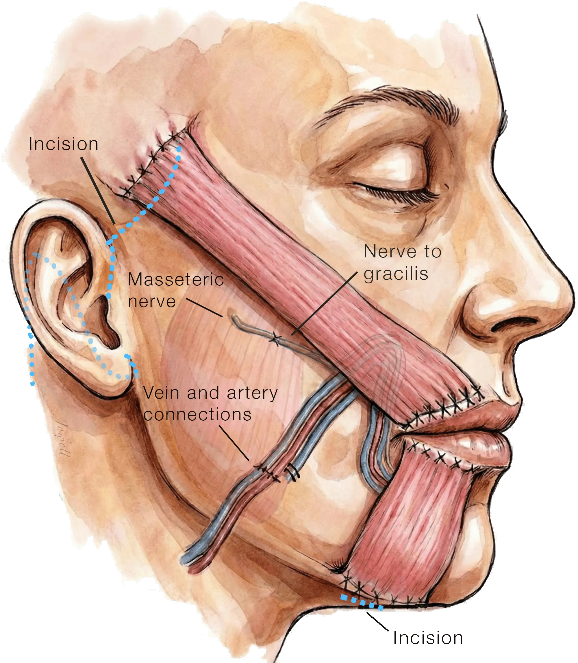 Dual-Vector Free Gracilis Muscle Transfer for Smile Reanimation Neurotized by Ipsilateral Masseteric Nerve