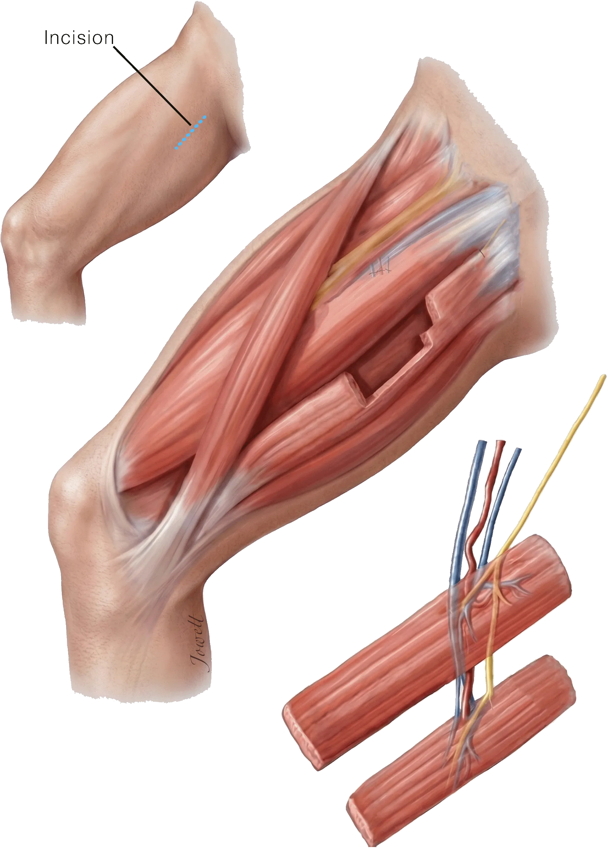 Gracilis Muscle Flap Harvest (Dual-Vector)