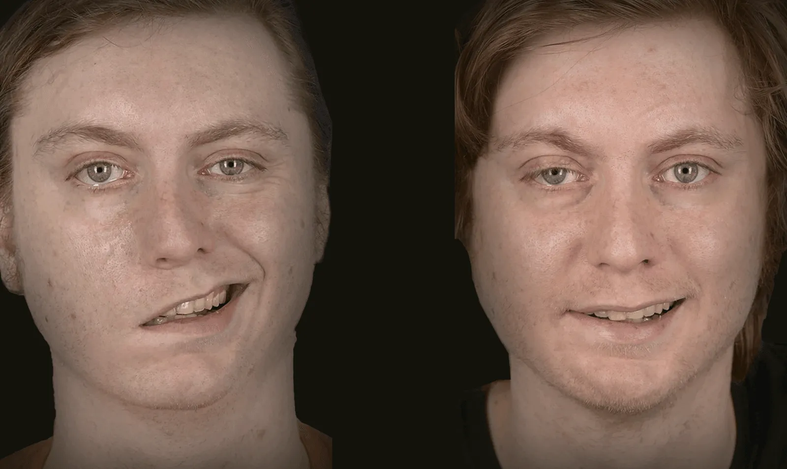 Before and after gunshot wound facial reconstruction