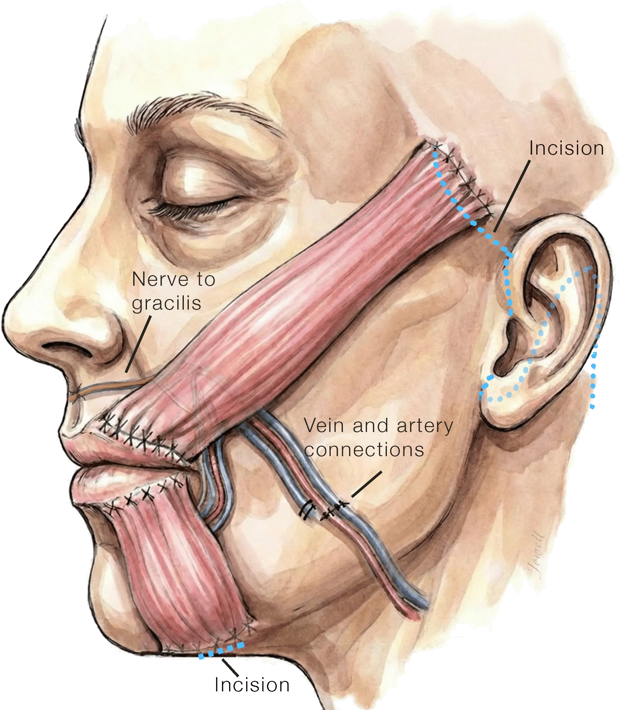 Free Gracilis Muscle Transfer