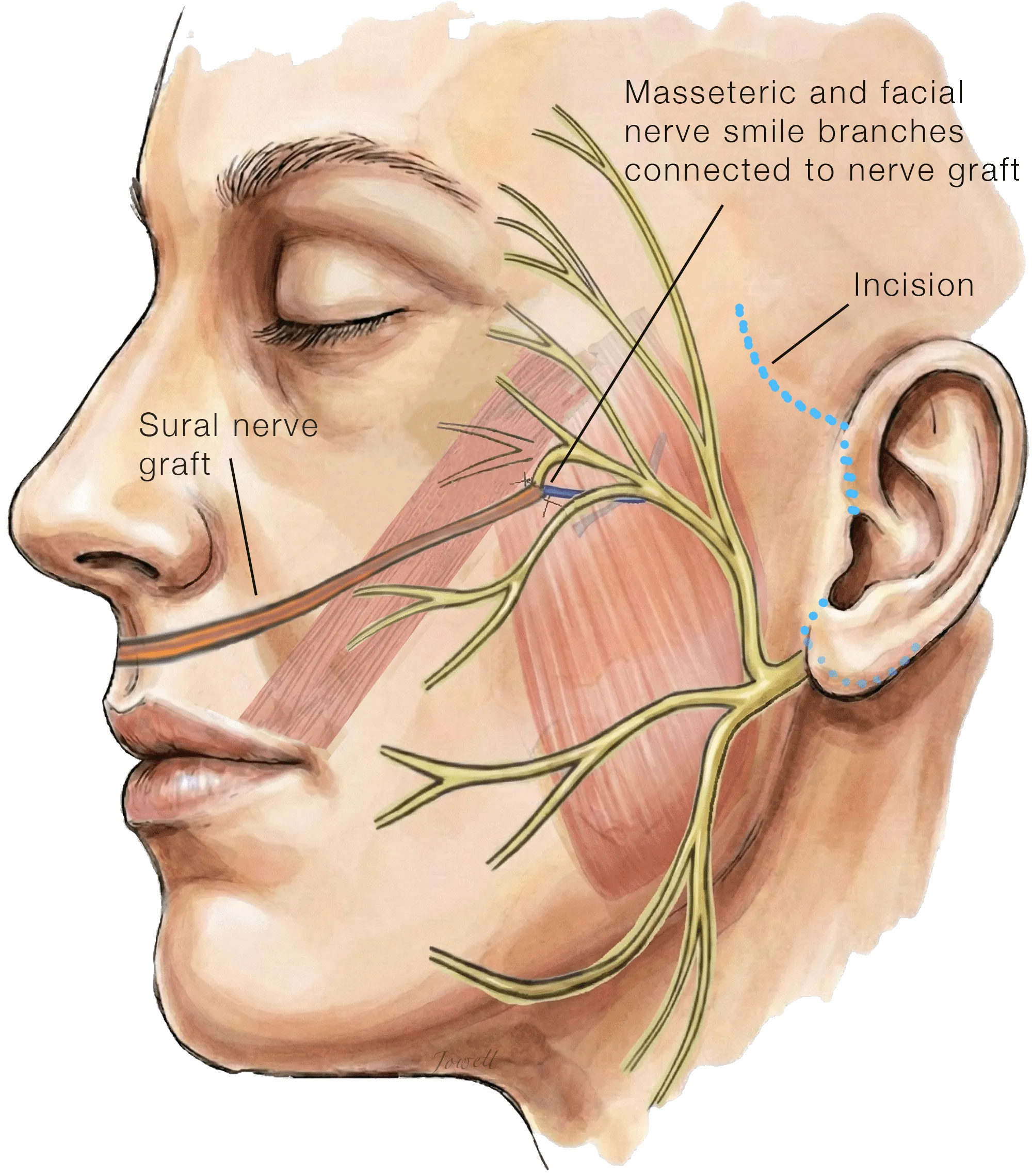 Masseteric to Facial Nerve Transfer