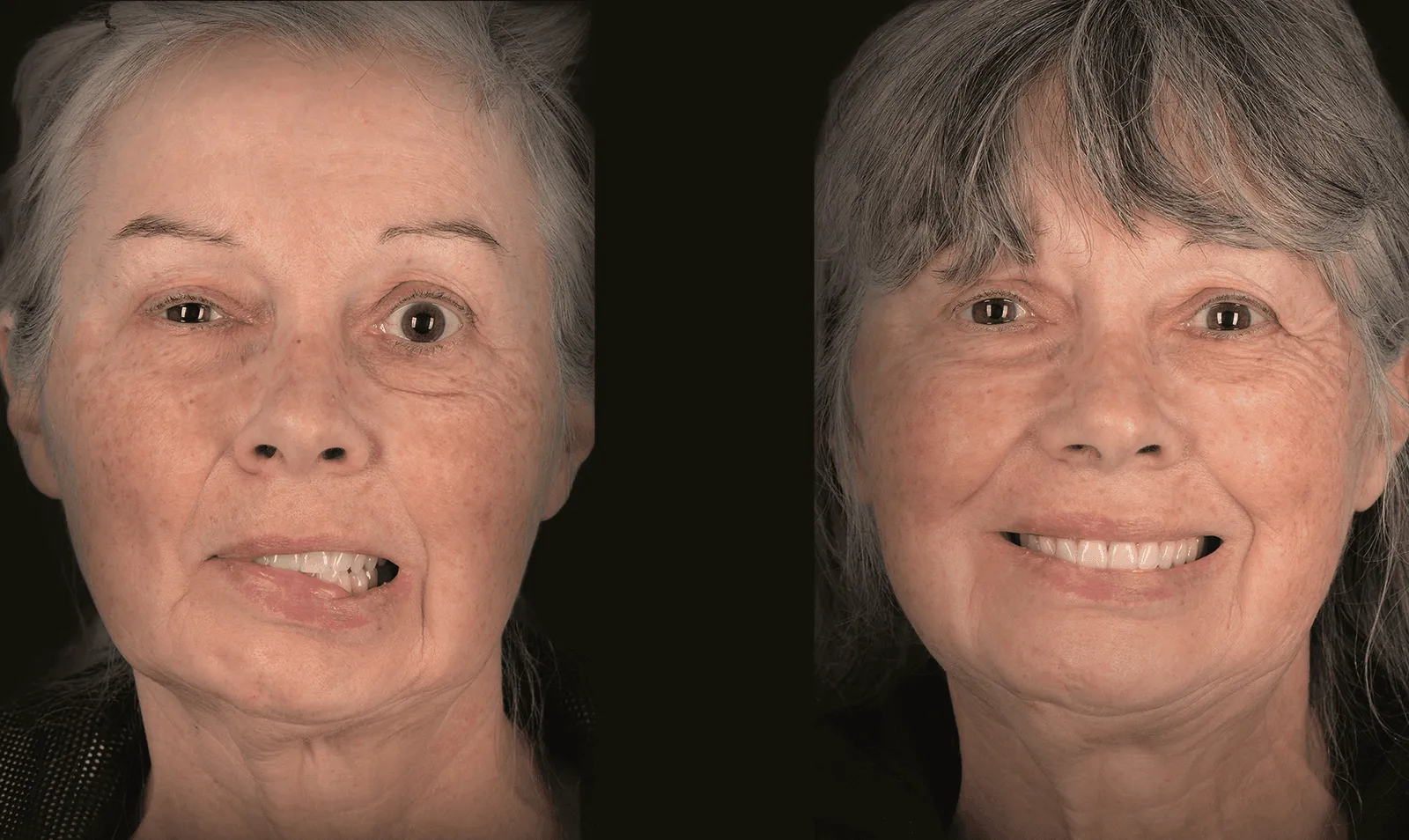 Before and after smile reanimation for facial synkinesis