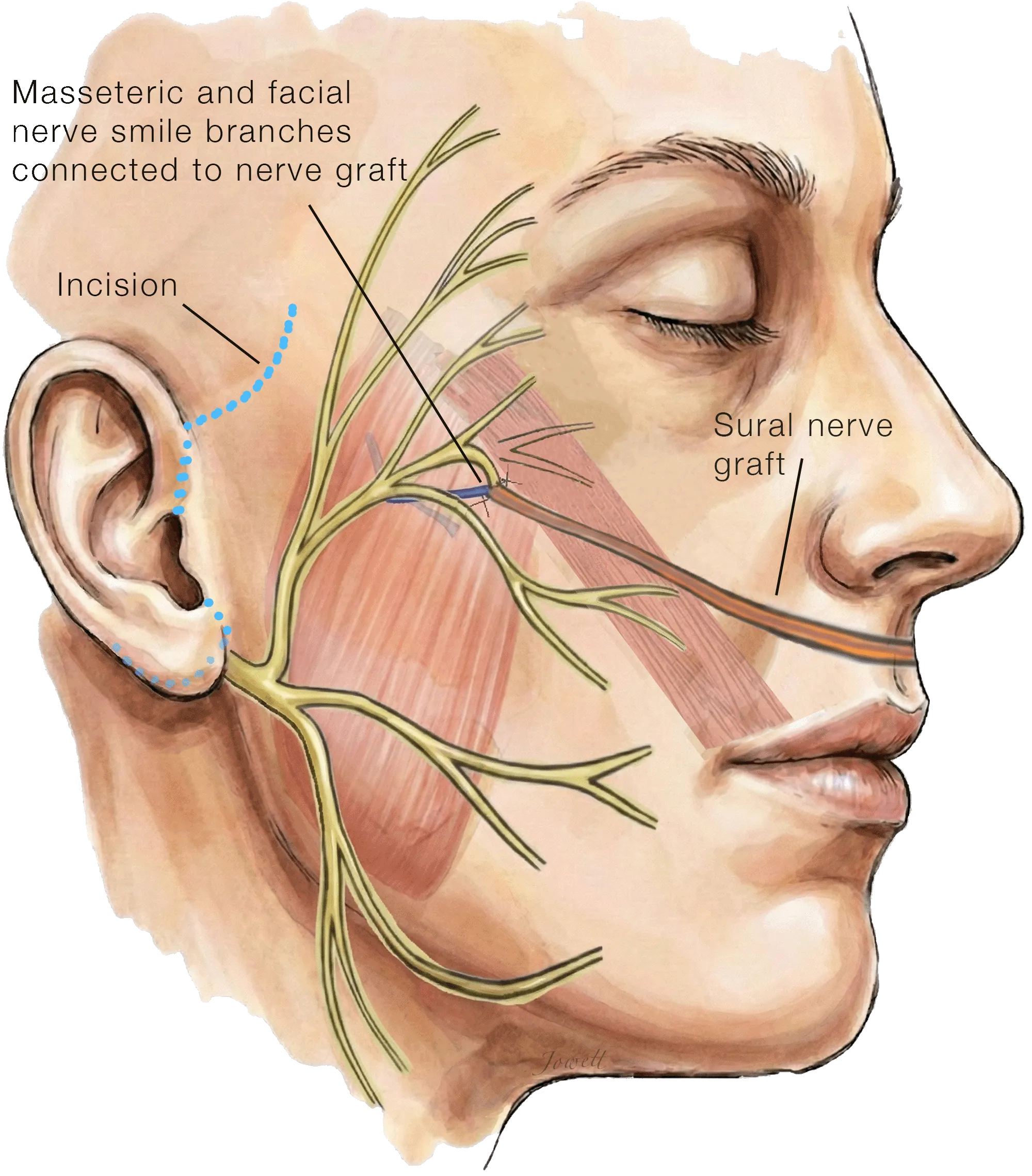 Illustration of a masseteric-supercharged cross-face nerve graft, with the masseteric nerve and the facial nerve smile branches joined to a sural nerve graft