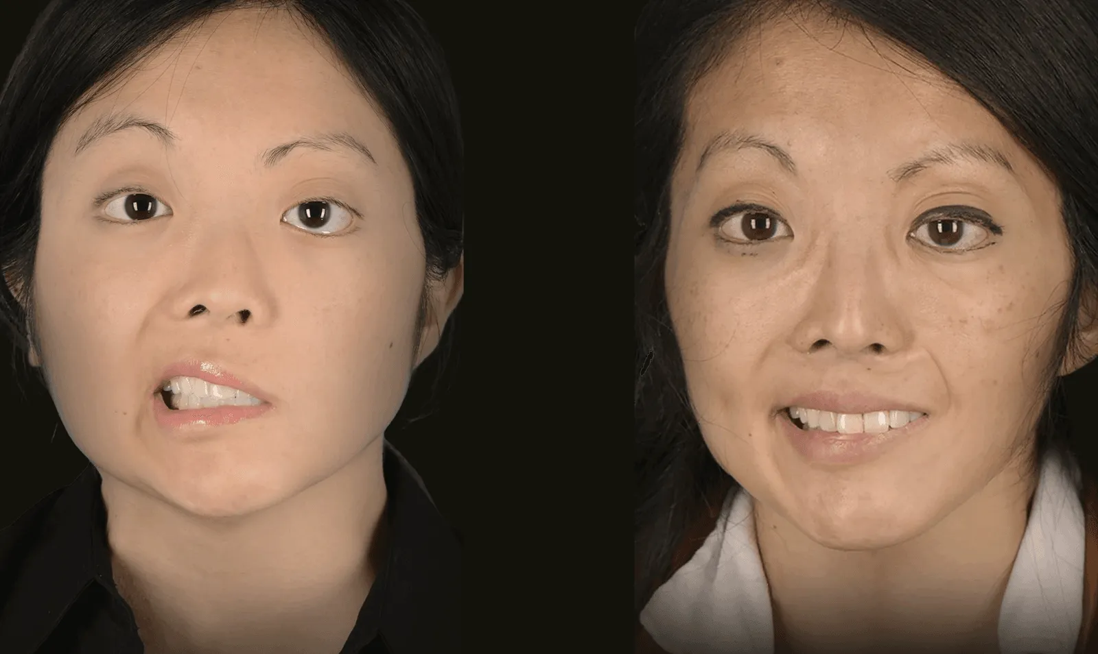 Before and after facial reanimation after acoustic neuroma