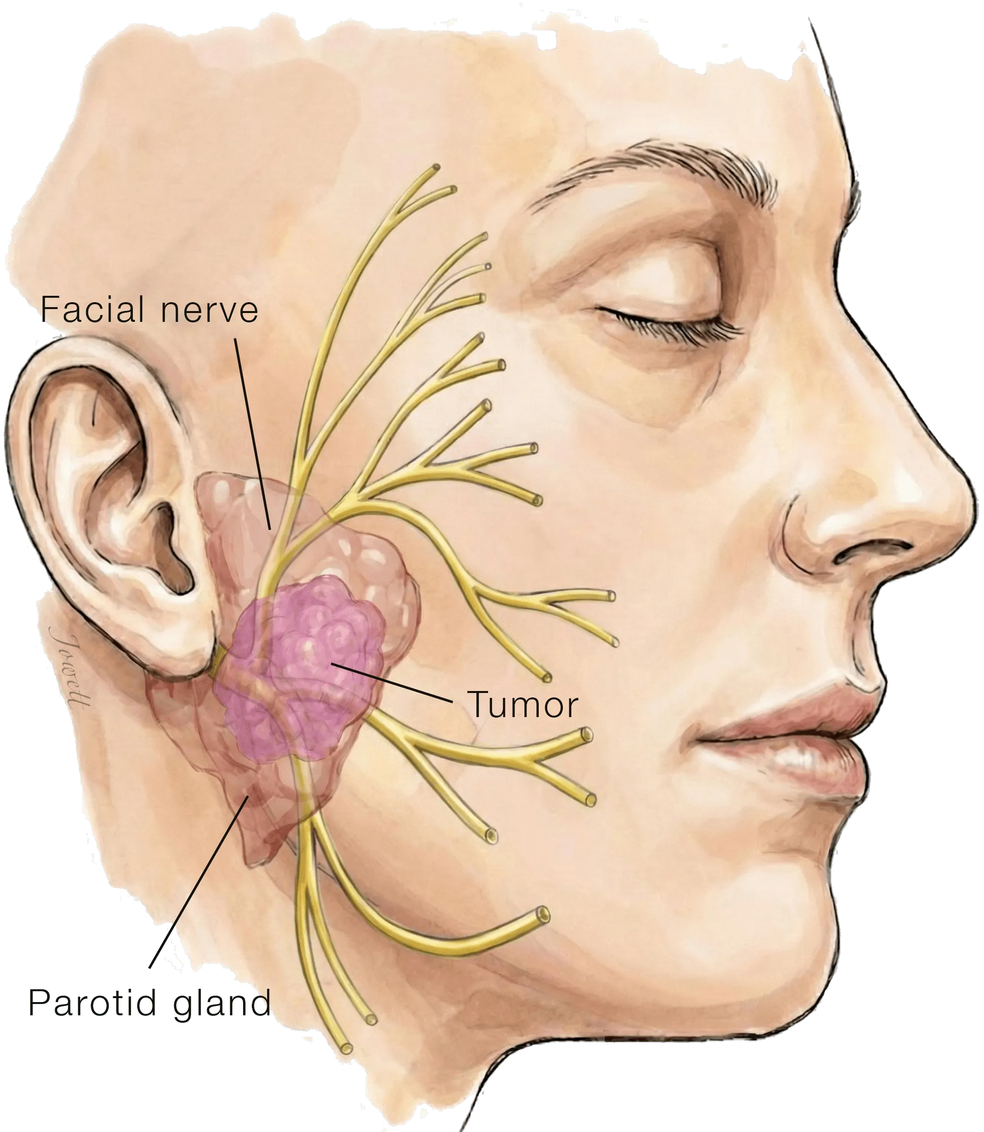 Illustration of a tumor inside the parotid gland, sitting among the branches of the facial nerve that fan out through the gland