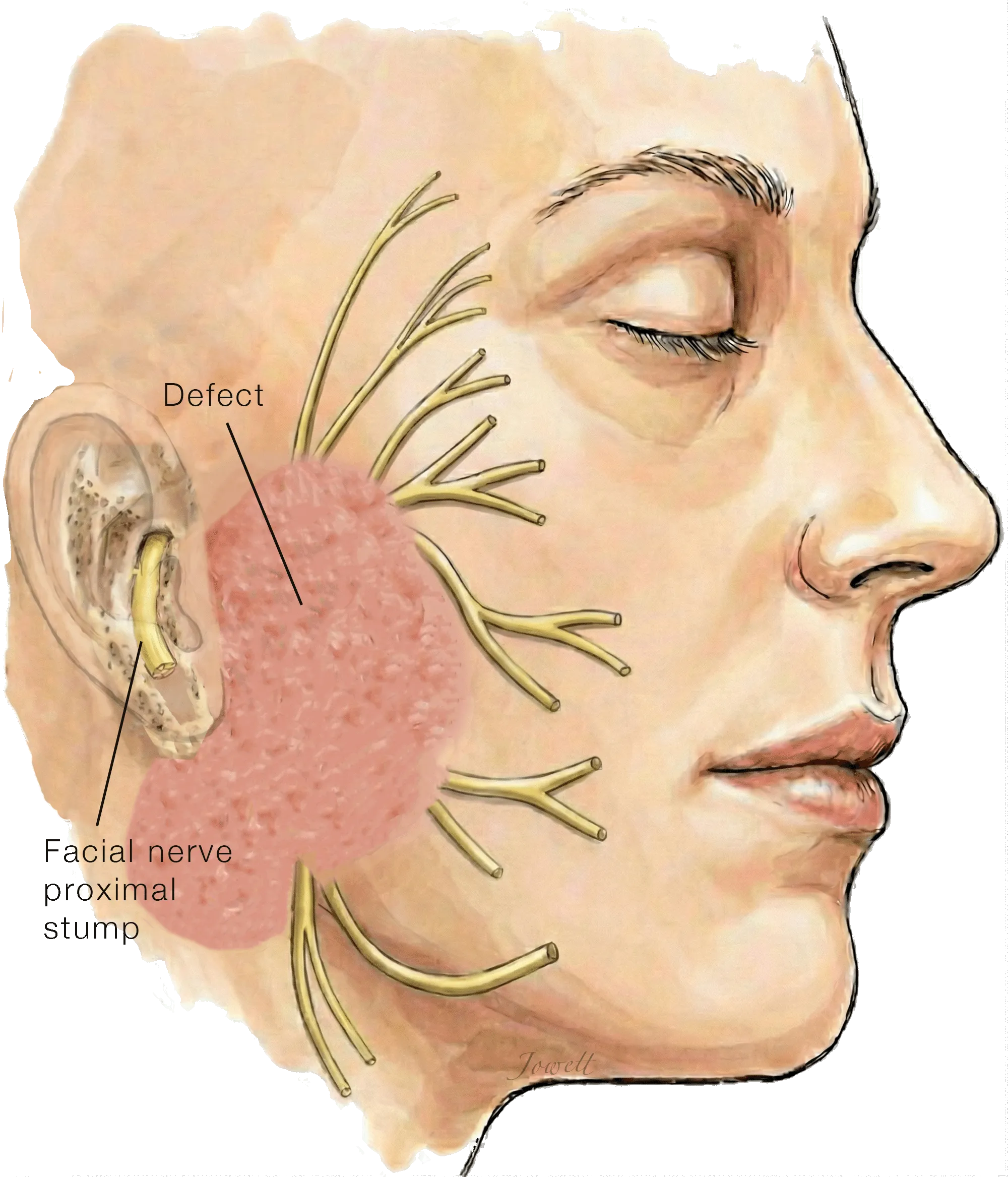 Illustration of the surgical defect after parotid tumor resection, showing the proximal facial nerve stump near the ear and the divided distal branches