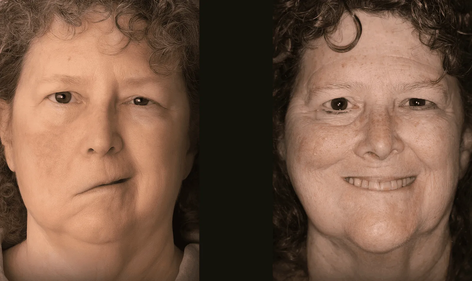 Before and after facial paralysis reconstruction following blood cancer treatment