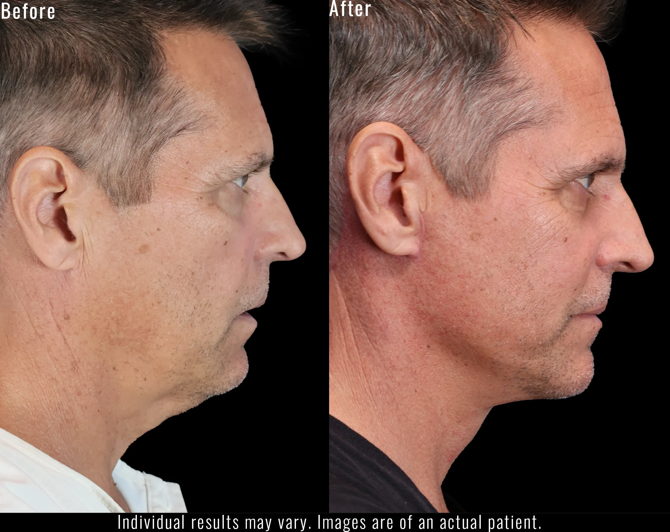 Before and after neck lift result