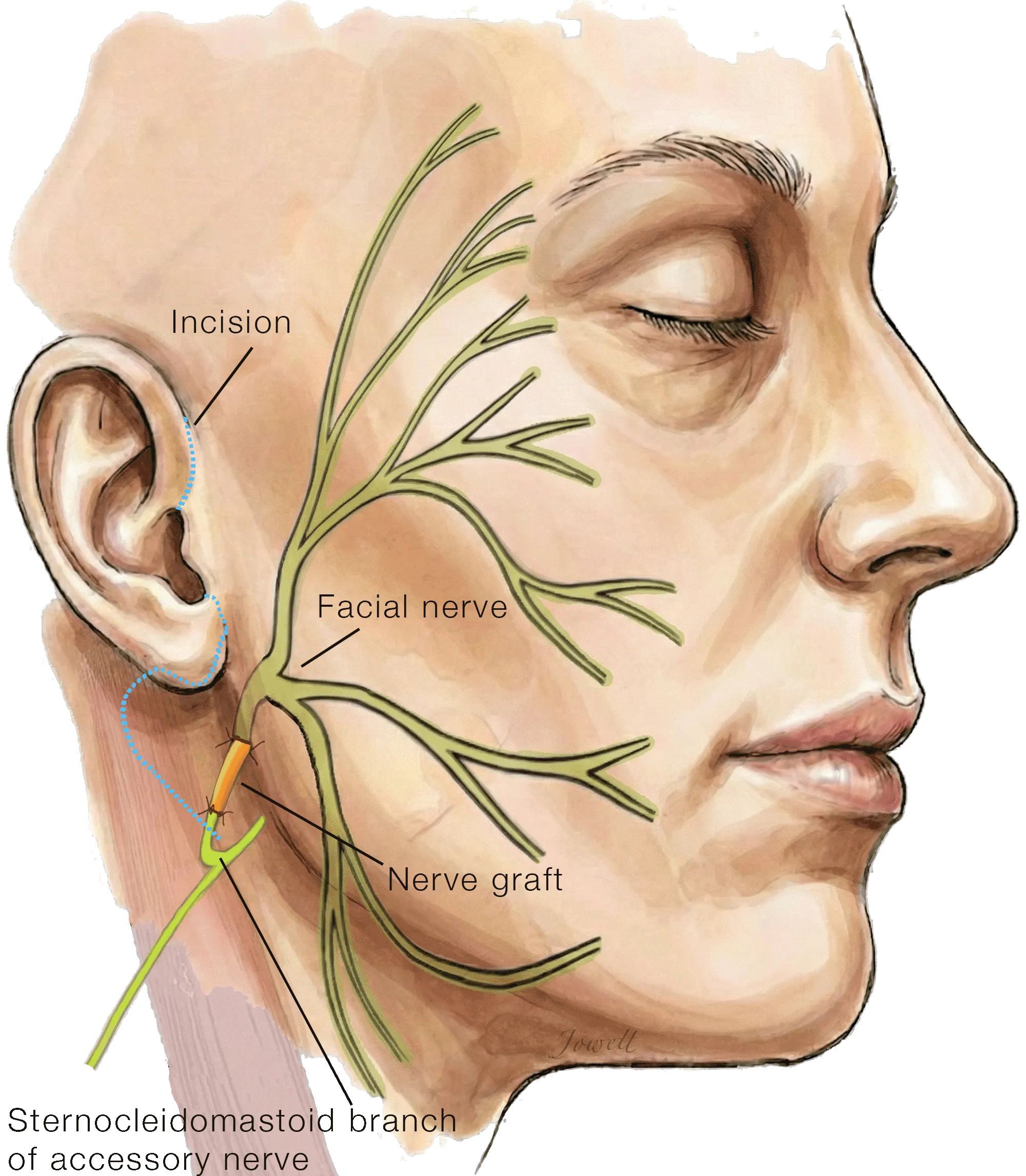 Spinal Accessory to Facial Nerve Transfer