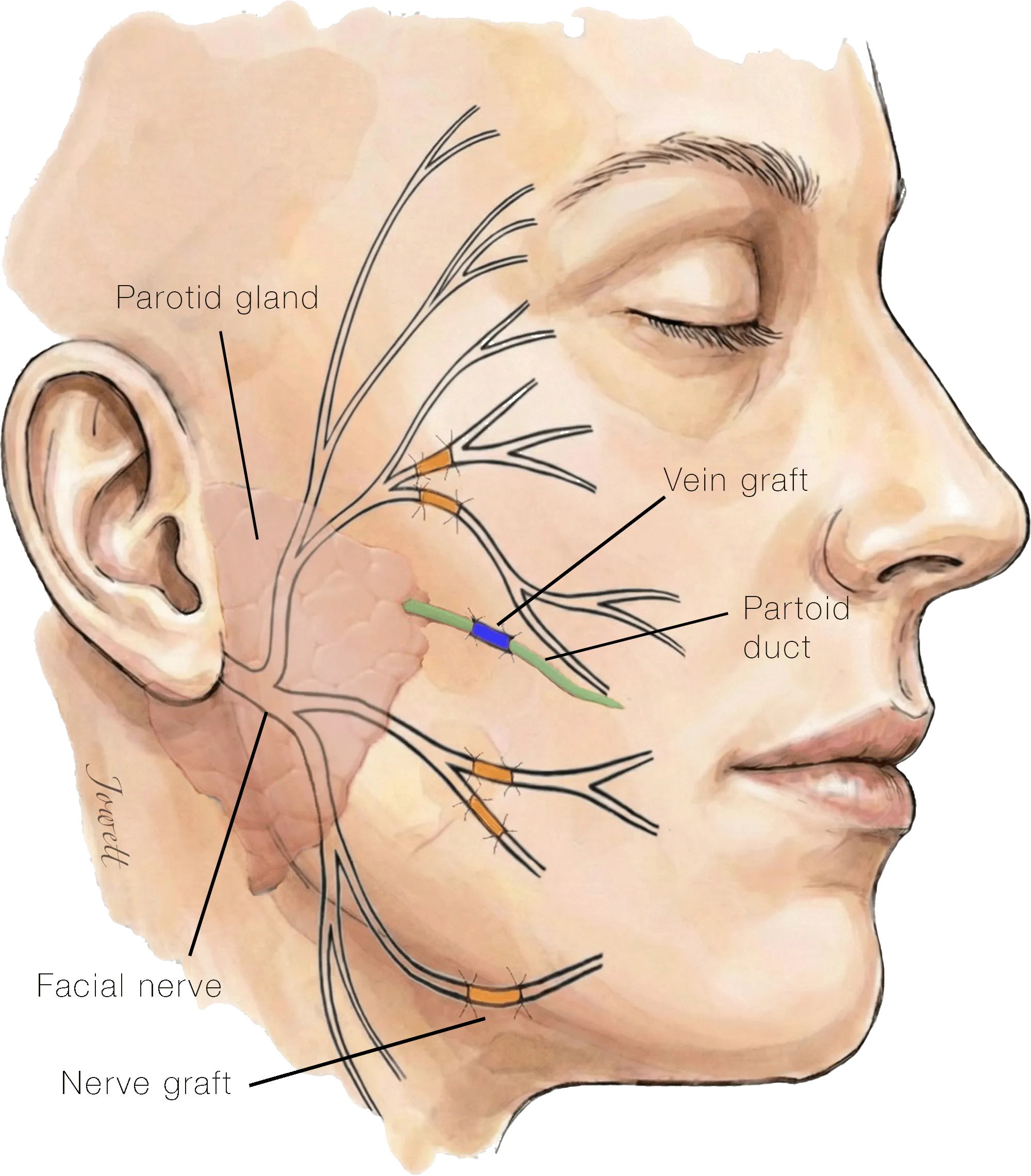 Illustration of a deep cheek injury repaired segment by segment, with interposition nerve grafts bridging each divided facial nerve branch and a vein graft restoring the parotid duct