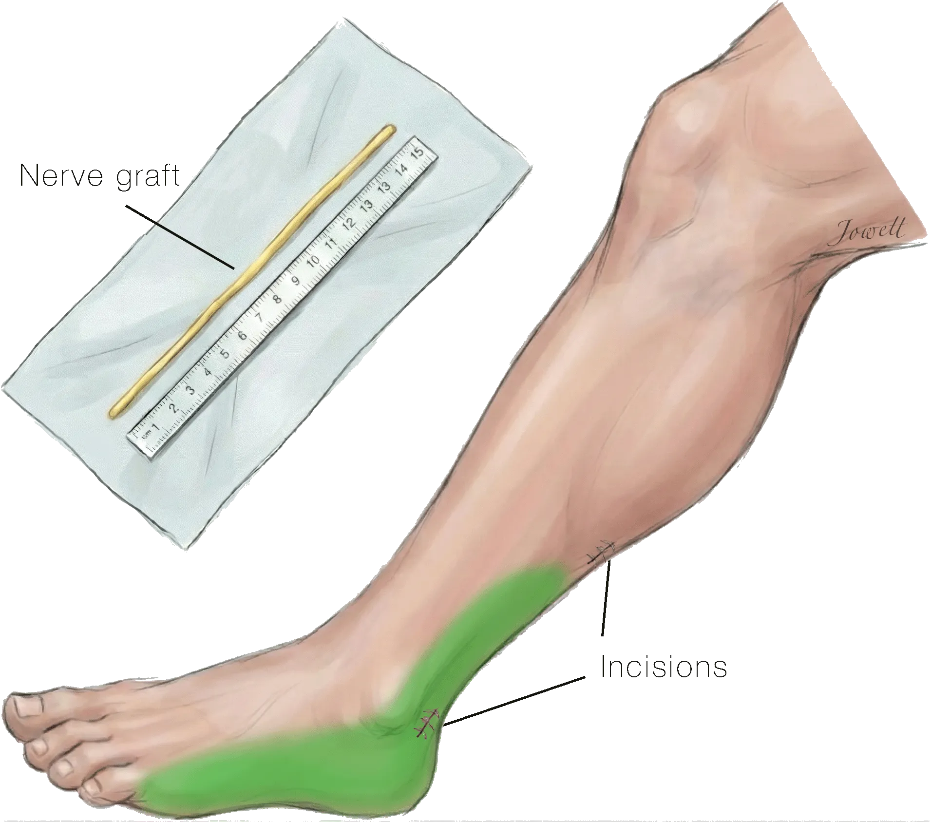 Illustration of sural nerve graft harvest through small calf and ankle incisions, with the resulting numb area shaded on the outer foot