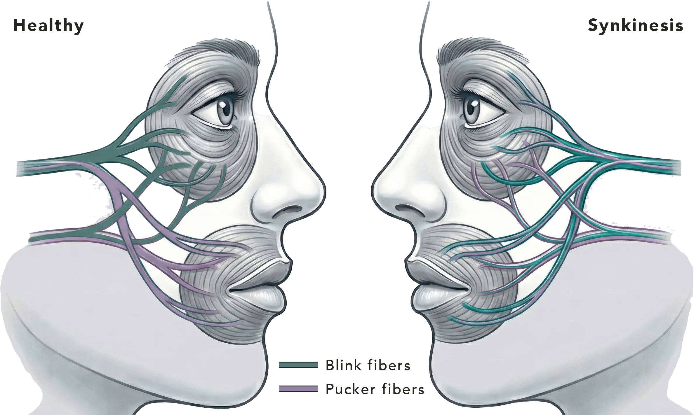 Illustration comparing a healthy face, where blink fibers and pucker fibers stay separate, with a synkinetic face, where regrown fibers reach both the eye and the mouth