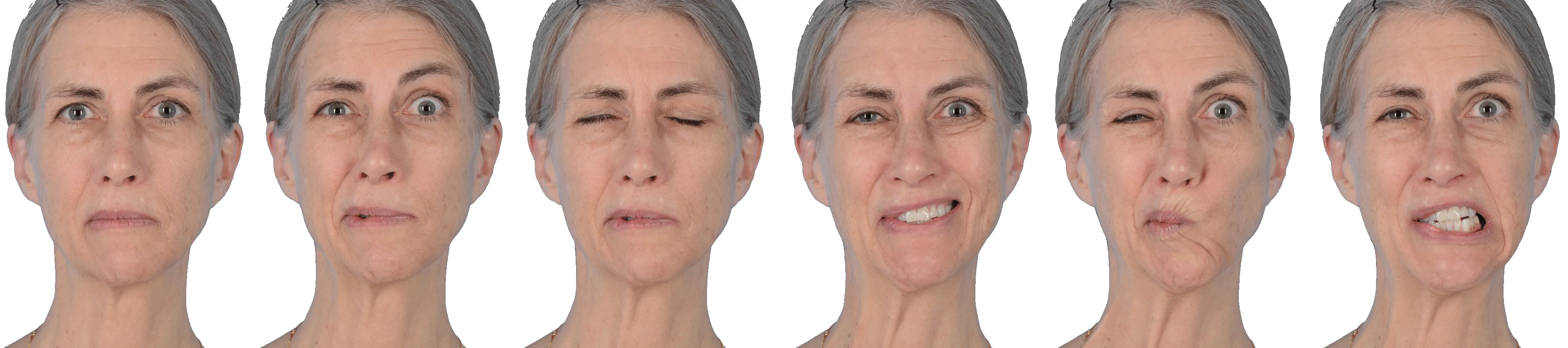 Sequential photographs showing synkinesis facial expressions