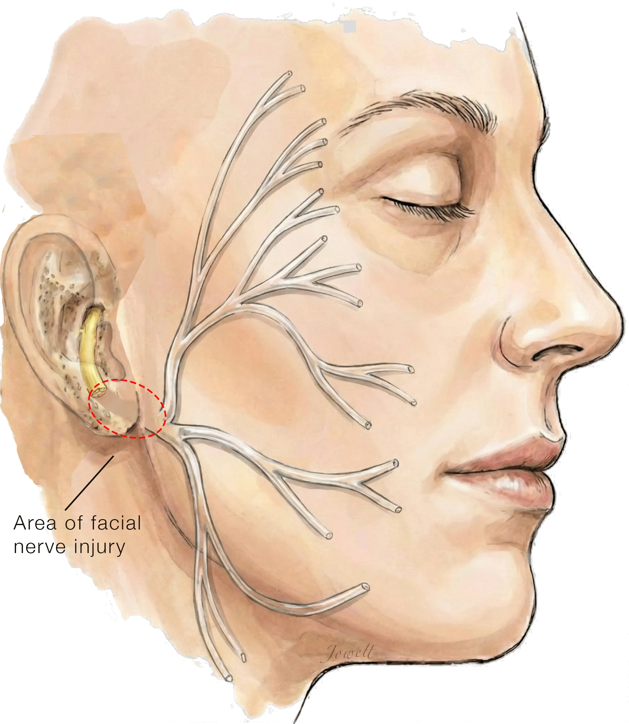 Illustration of an injury to the facial nerve trunk below the ear, with the downstream branches drawn pale to show muscles that have lost their nerve supply