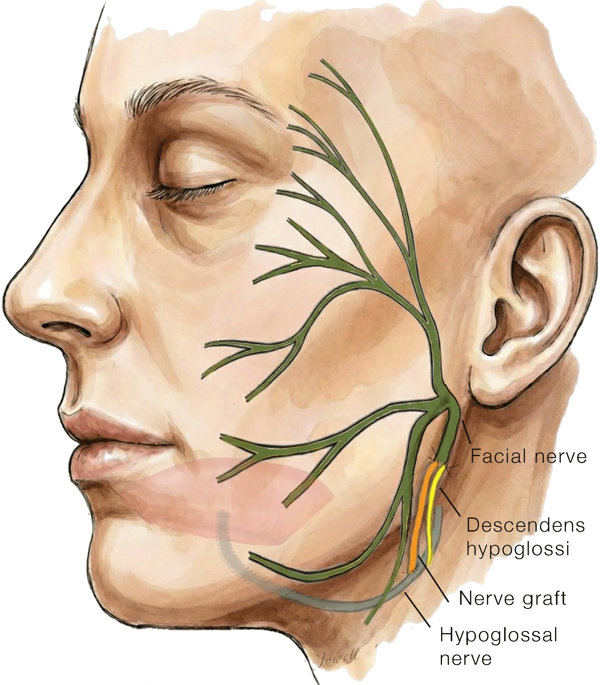 Illustration of a hypoglossal-to-facial nerve jump graft, with a nerve graft running from the partly divided hypoglossal nerve to the facial nerve