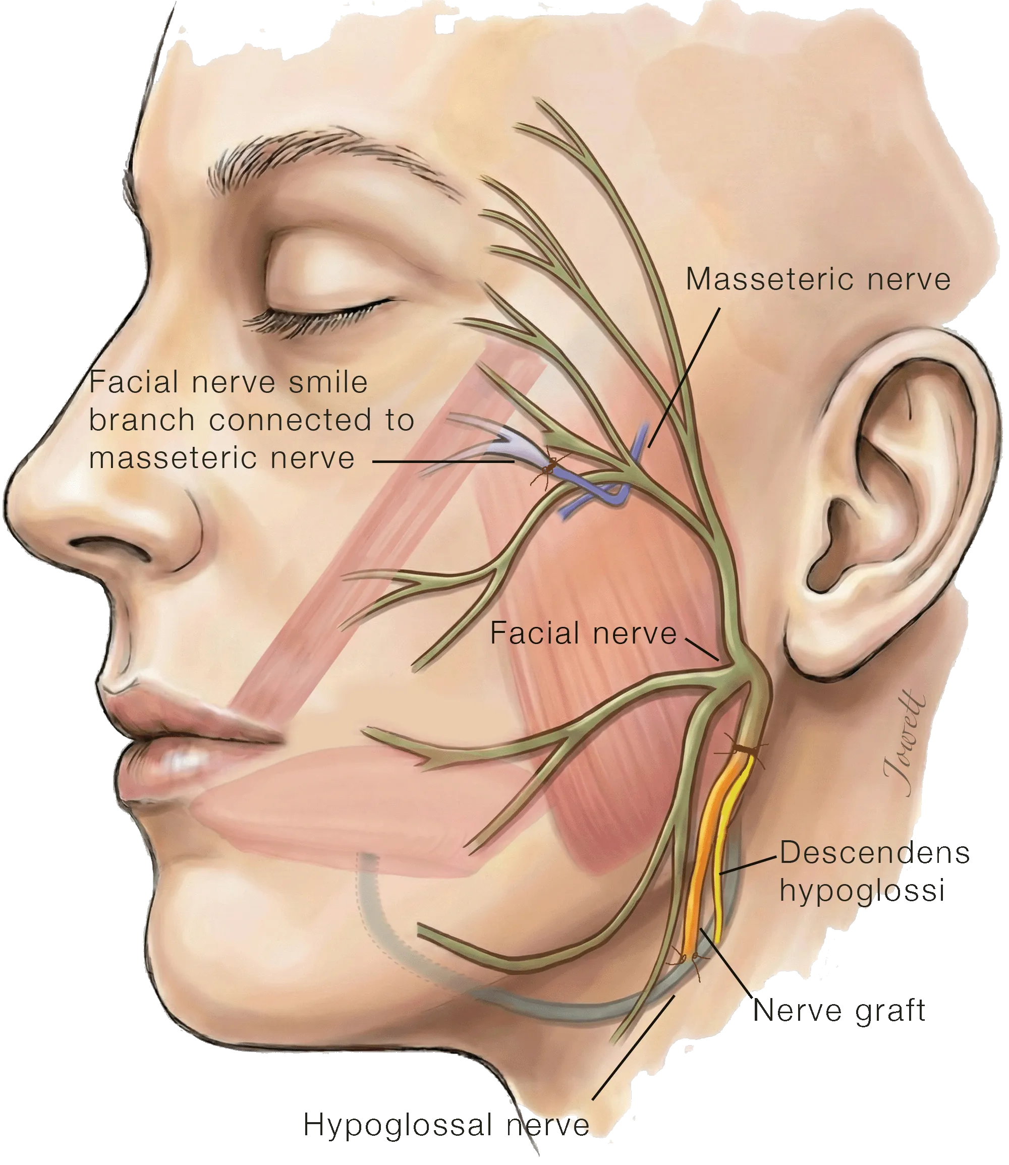 Multiple Nerve Transfer for Facial Reanimation (Hypoglossal, Descendens Hypoglossi, Masseteric)