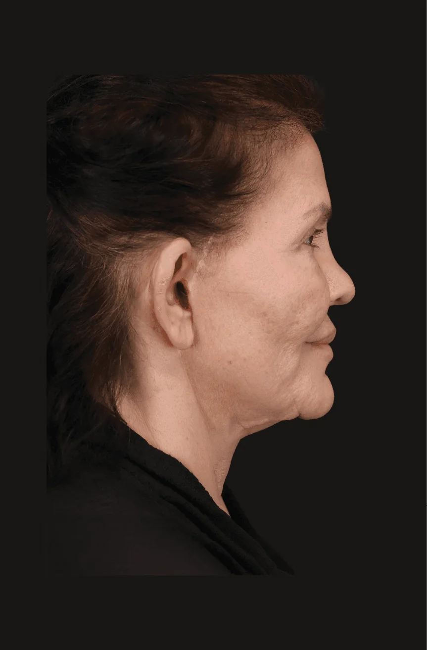 Before Secondary Facelift, Right lateral view