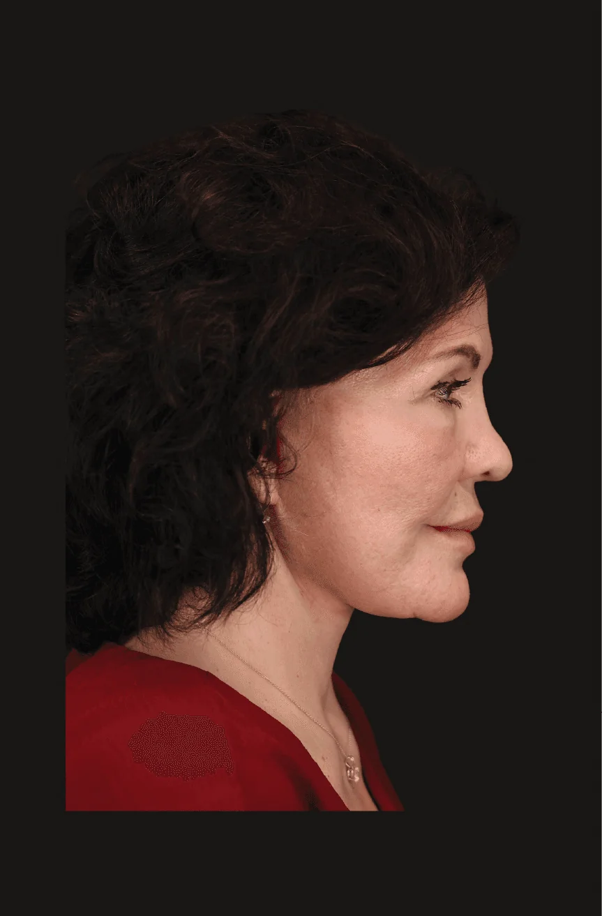 Six-month before-and-after revision deep plane facelift and structural neck lift case by Dr. Nate Jowett.
