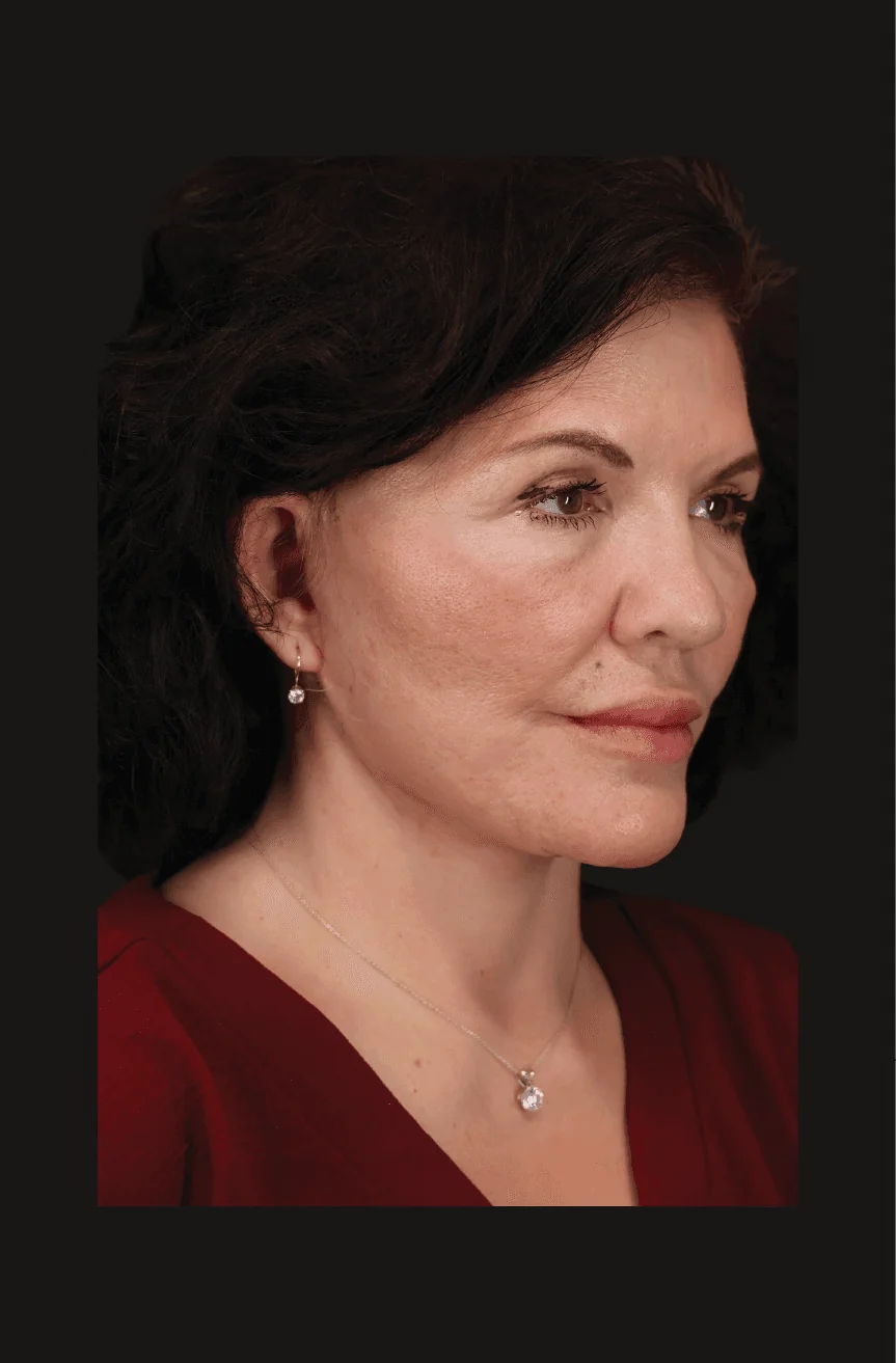 Six-month postoperative Secondary Facelift, Right Oblique thumbnail