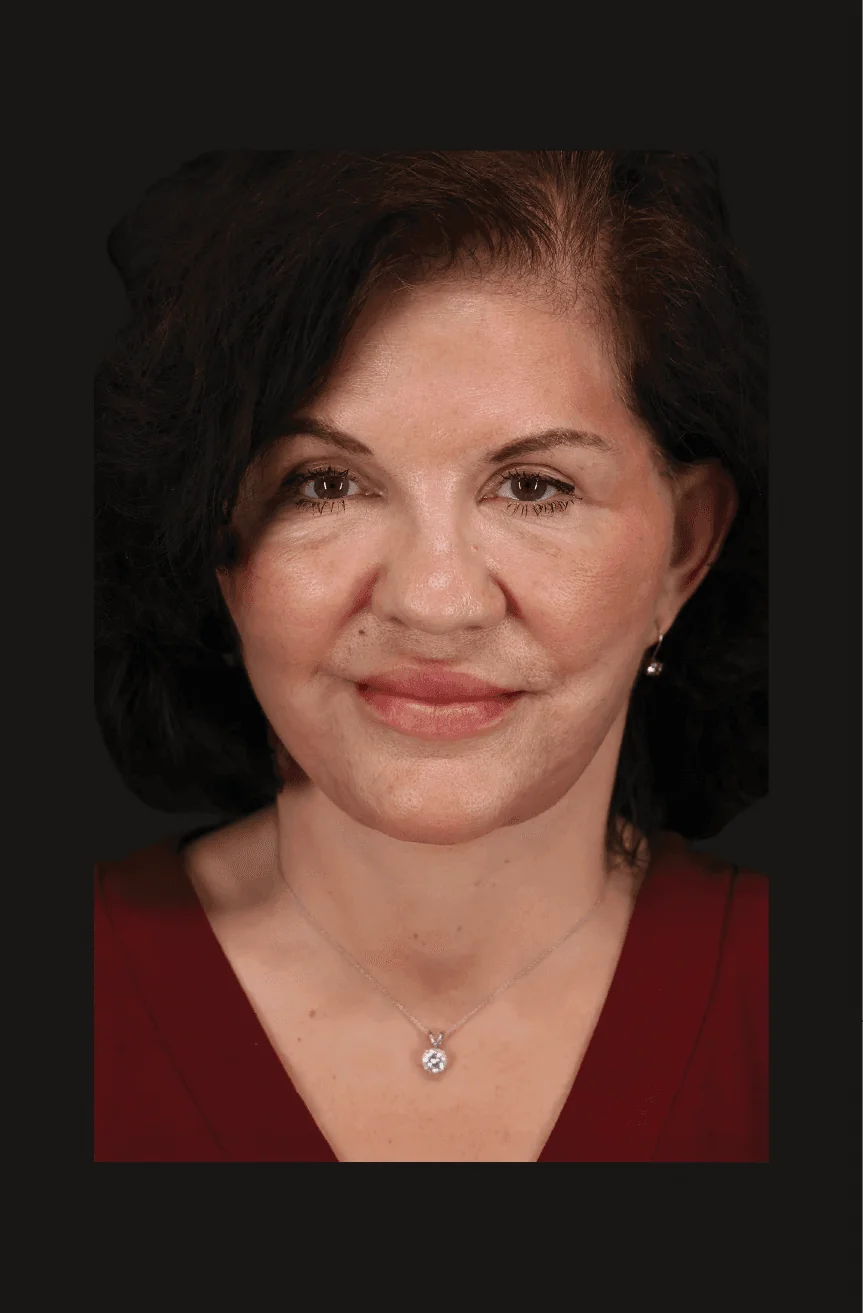 Six-month postoperative Secondary Facelift, Profile thumbnail
