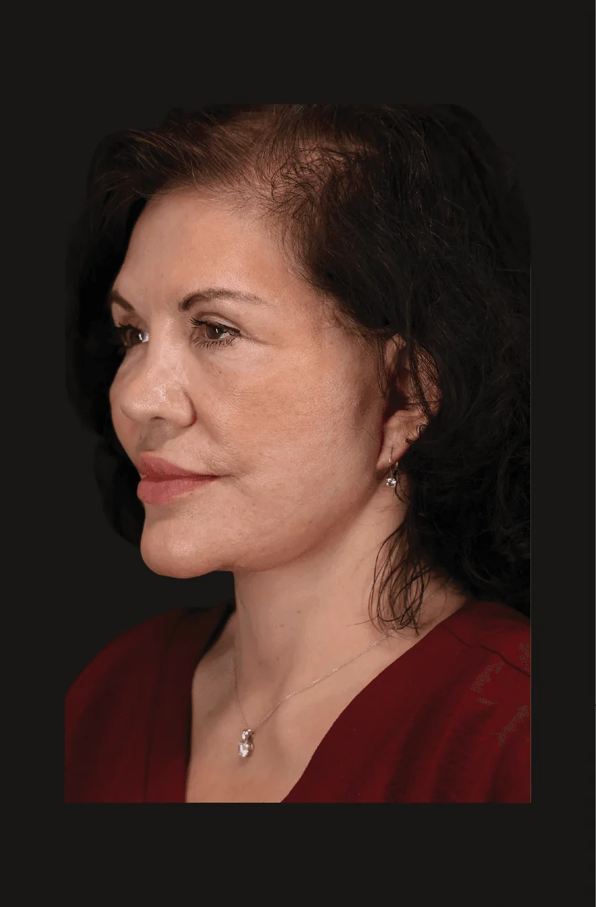 Six-month postoperative Secondary Facelift, Left Oblique thumbnail