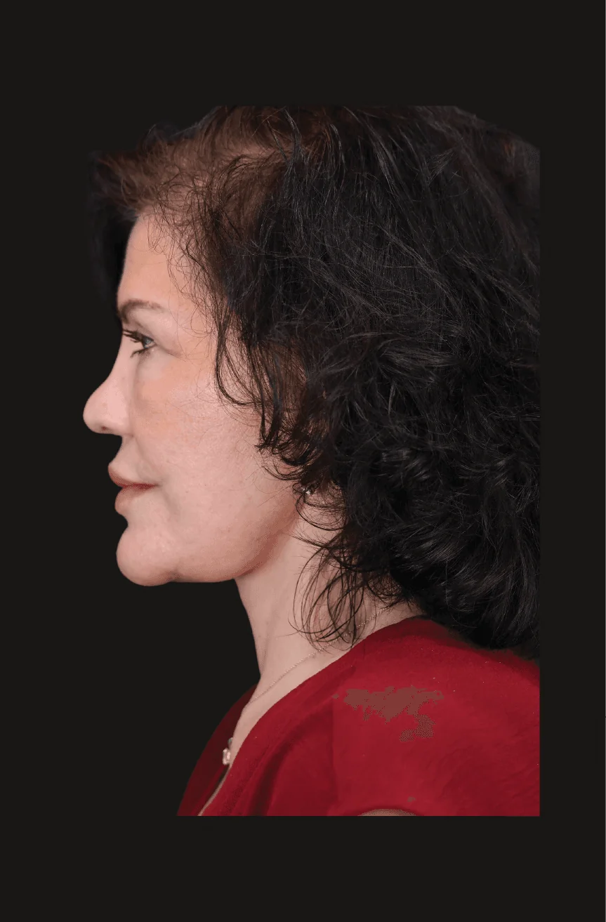 Six-month postoperative Secondary Facelift, Left Lateral thumbnail