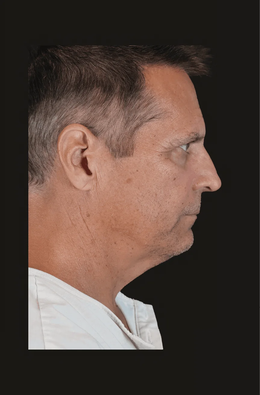 Before Primary Structural Neck Lift, Right lateral view