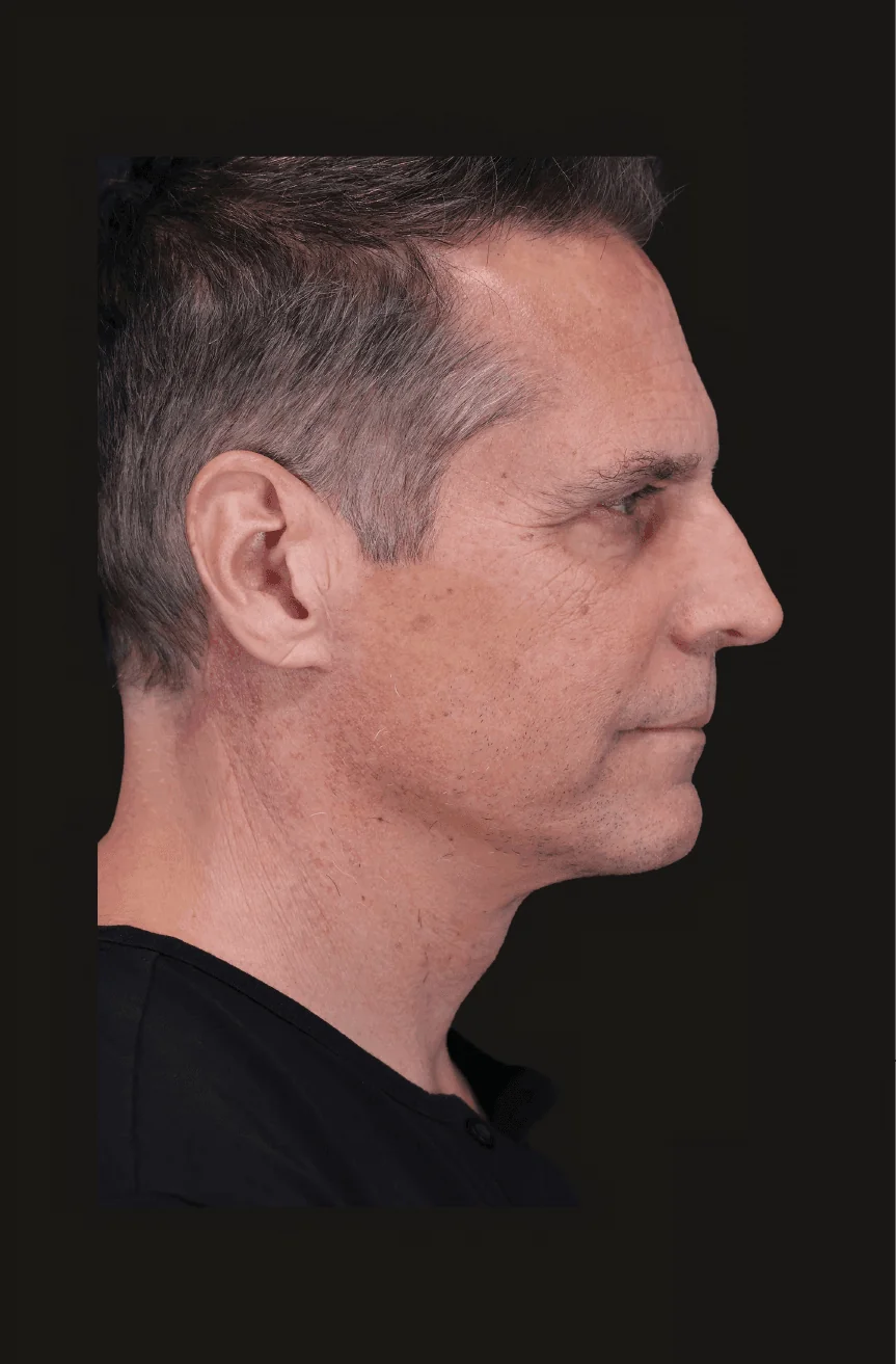 Six-month before-and-after structural neck lift and deep platysmaplasty case by Dr. Nate Jowett.