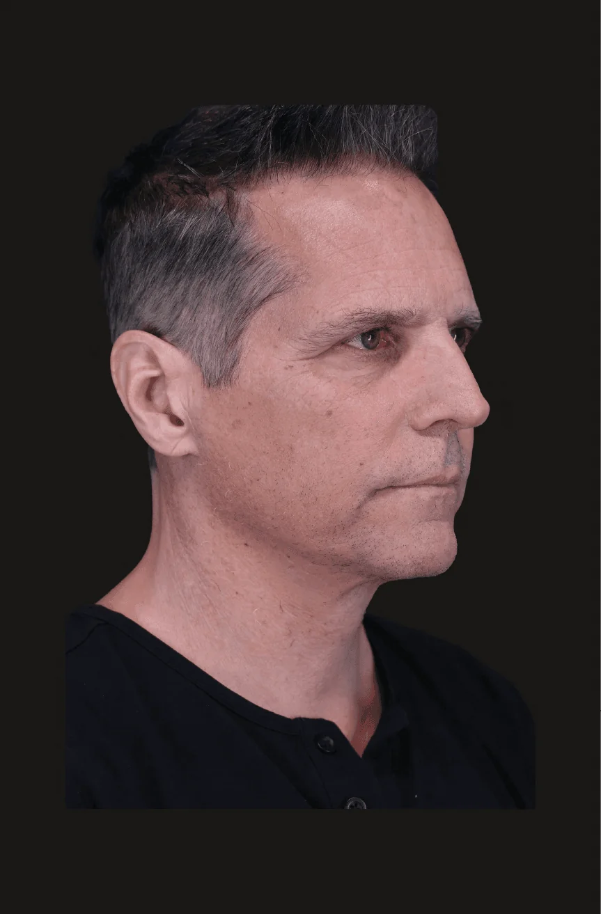 Six-month postoperative Primary Structural Neck Lift, Right Oblique thumbnail