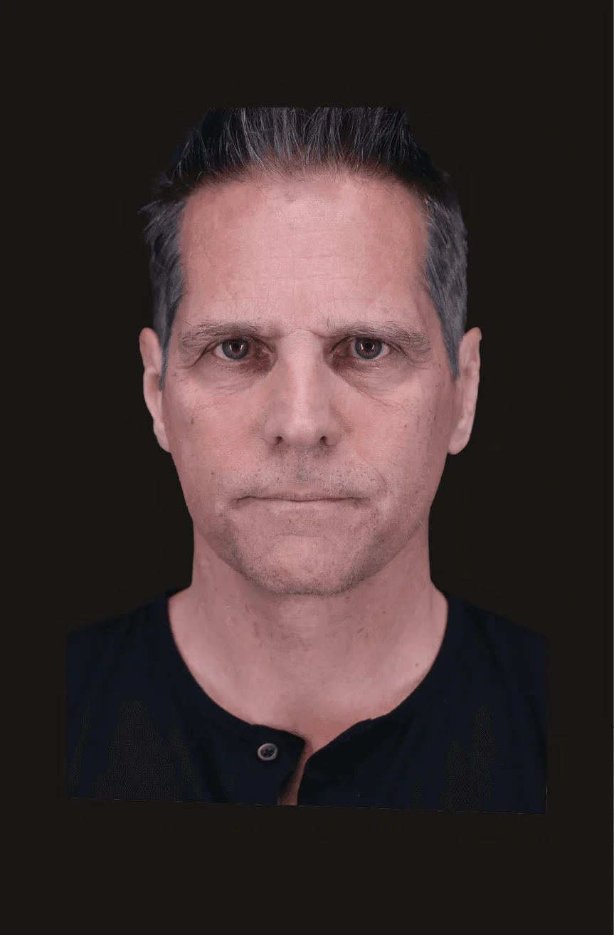 Six-month postoperative Primary Structural Neck Lift, Profile thumbnail