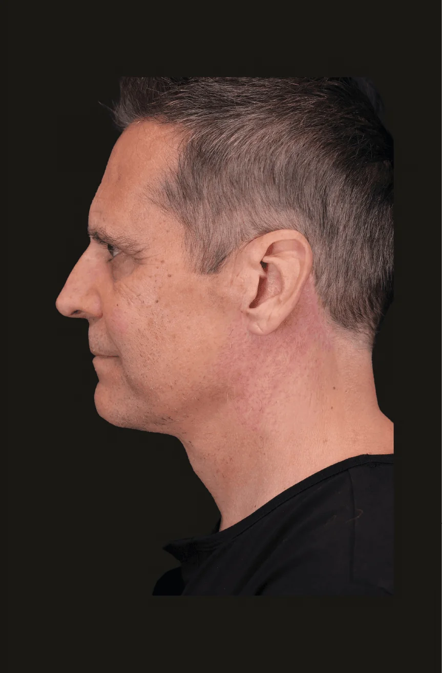 Six-month postoperative Primary Structural Neck Lift, Left Lateral thumbnail