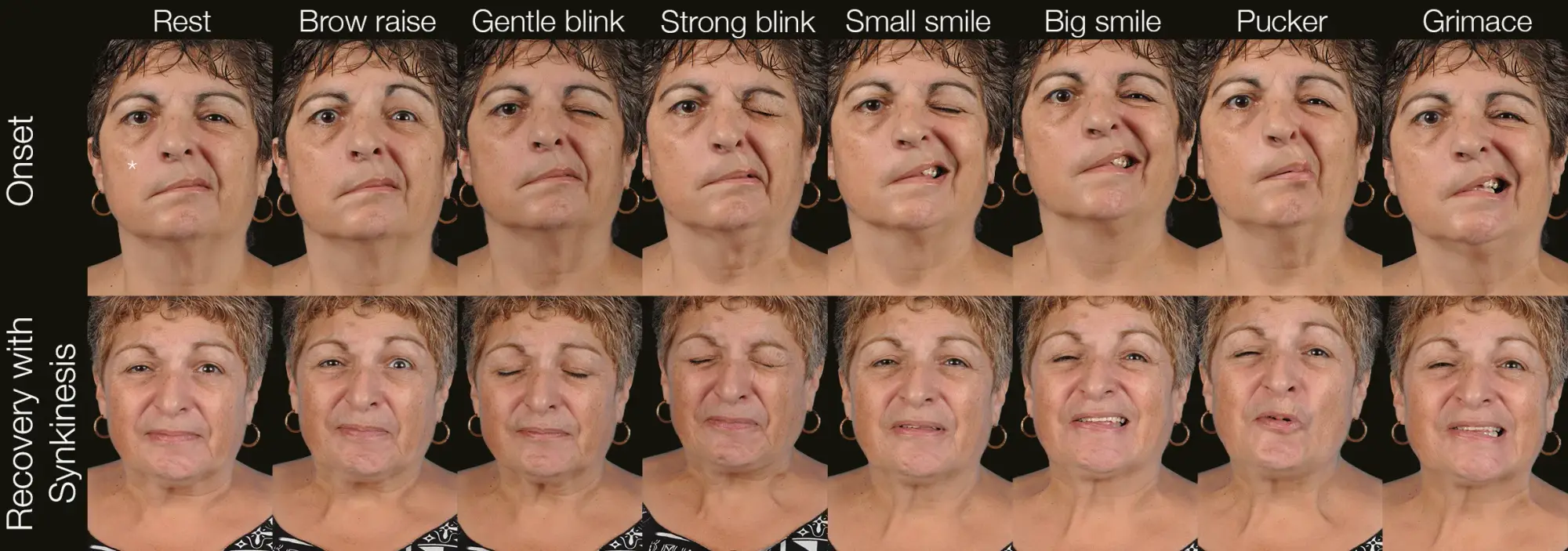 Progression from Acute Flaccid Paralysis to Facial Synkinesis