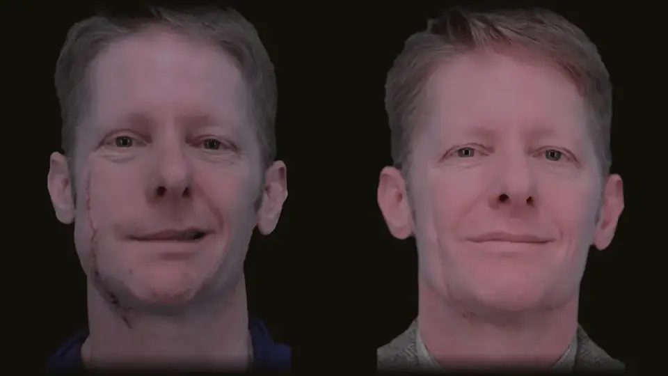Facial paralysis and salivary duct damage from a chainsaw. Repaired with a nerve graft and duct reconstruction. Result 9 months later.